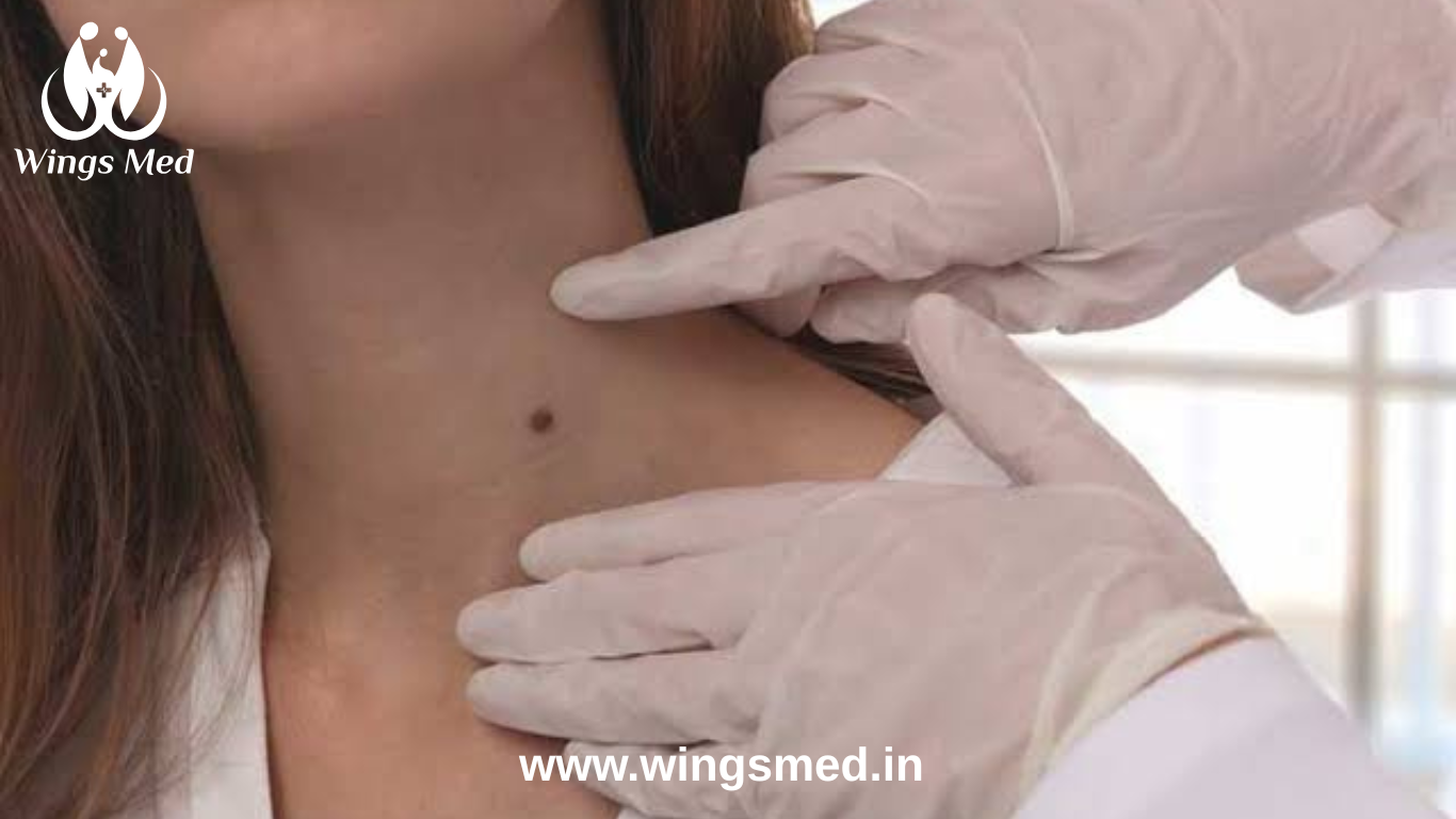 benign tumor